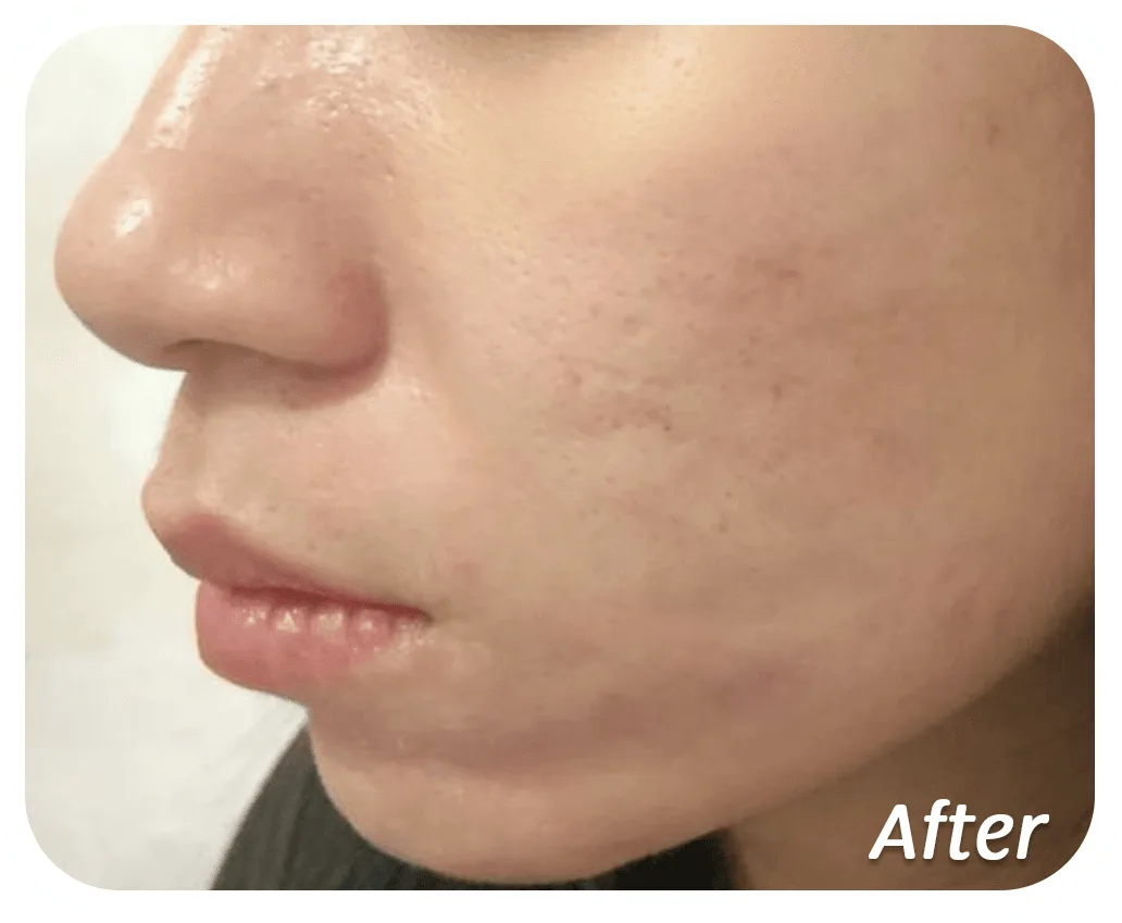 After-Acne-Scar-1.png