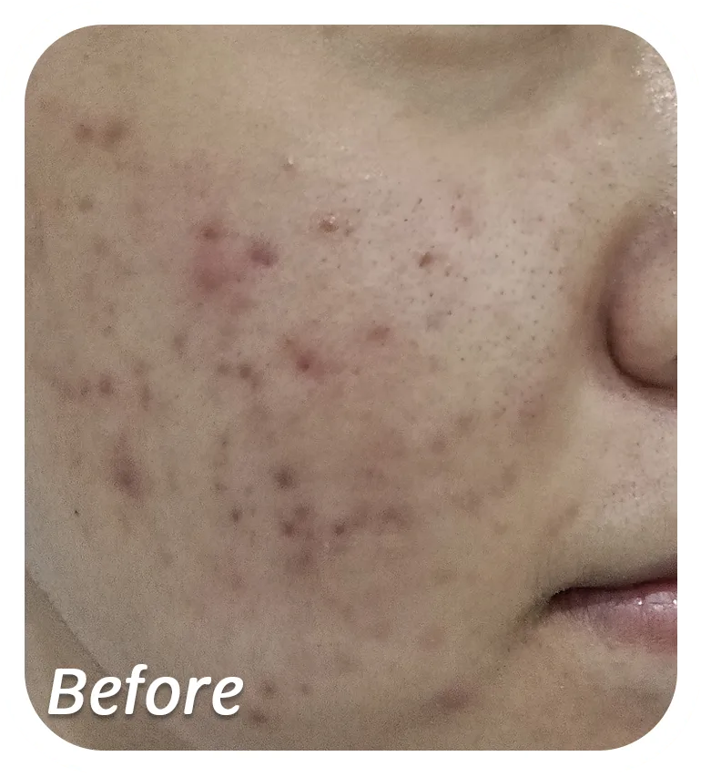 Before-Acne-2.png Before-Acne-2.png