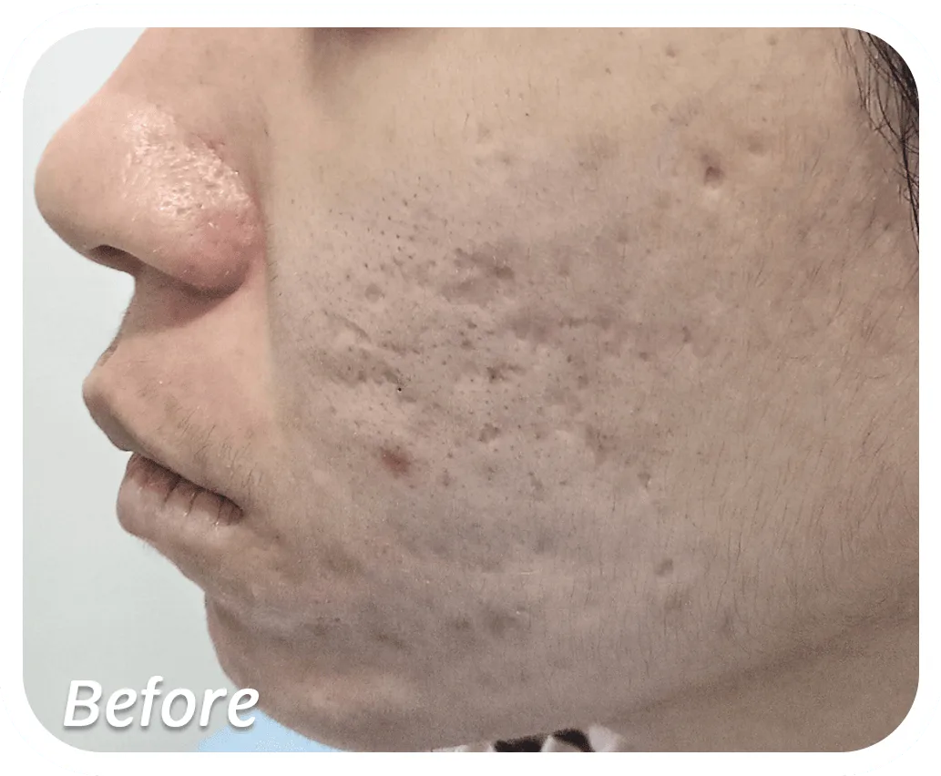 Before-Acne-Scar-1.png Before-Acne-Scar-1.png