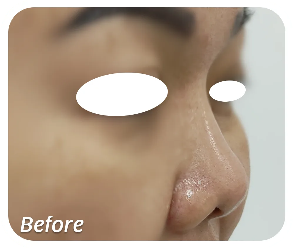 Before-Benang-Hidung.png Before-Benang-Hidung.png