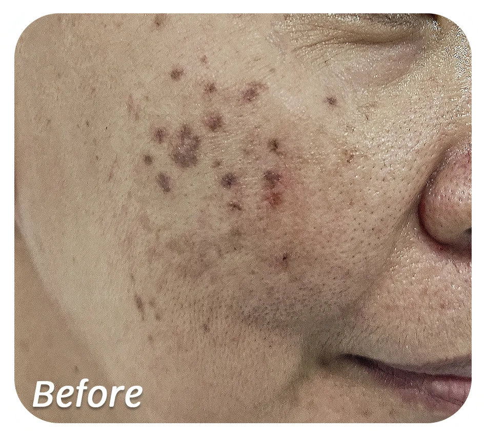 Before-Flek.png Before-Flek.png