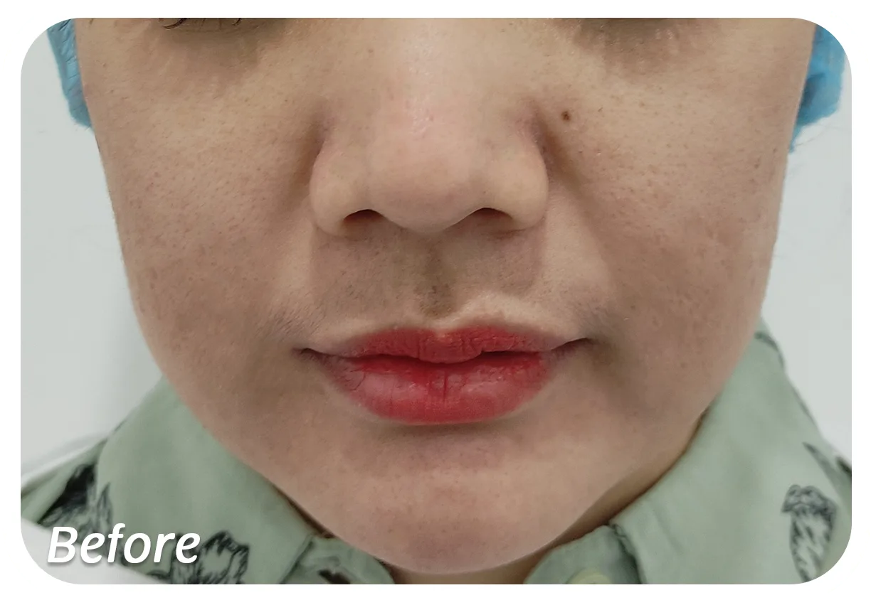 Before-Pipi-Kendur.png Before-Pipi-Kendur.png